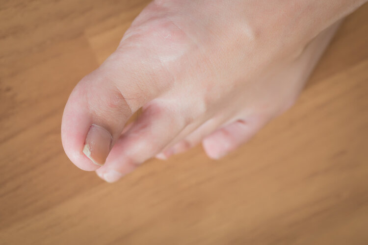 脚趾甲长肉里一碰就痛解决方法,脚趾甲长到肉里一碰就疼如何解决