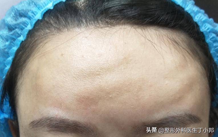 额头填充成寿星公怎么办,额头太尖而窄怎么填充