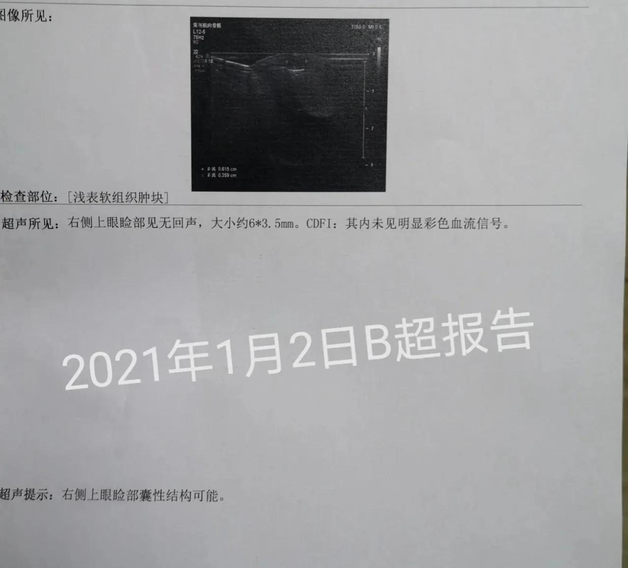 孩子头部皮脂腺囊肿能保守治疗吗,孩子面部皮脂腺囊肿