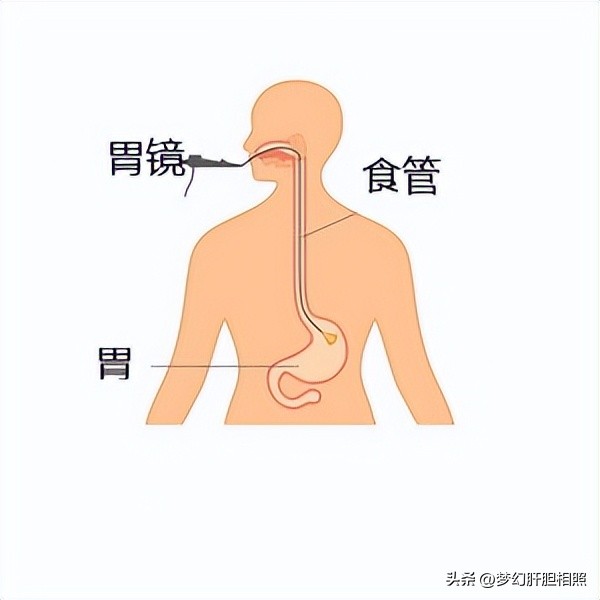 什么是微创手术机器,什么是微创手术是大手术