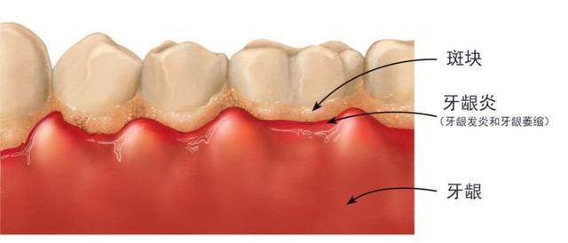 怎么根治一上火就牙疼,一上火就牙疼是牙髓炎么
