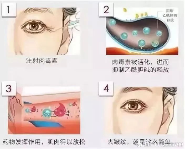 肉毒素注射后的注意事项有哪些,涂抹肉毒素和注射肉毒素