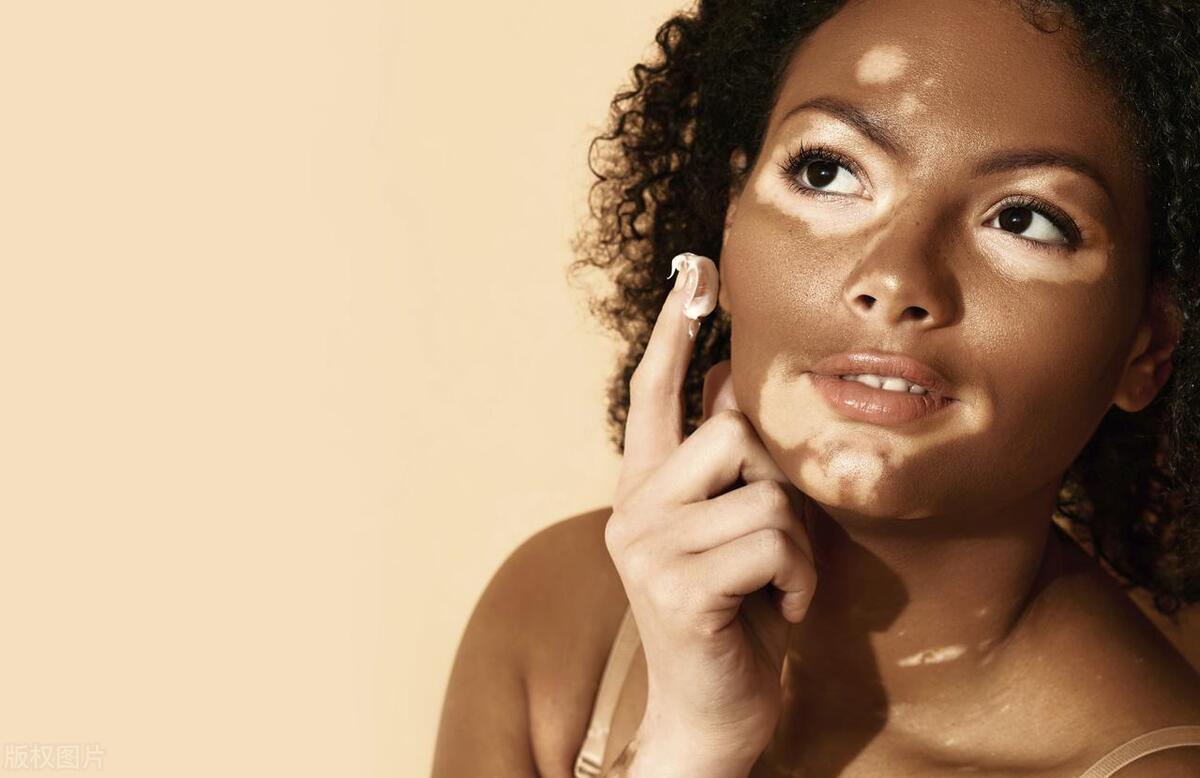 得了白癜风对寿命有影响吗,得了白癜风会对生活有什么影响