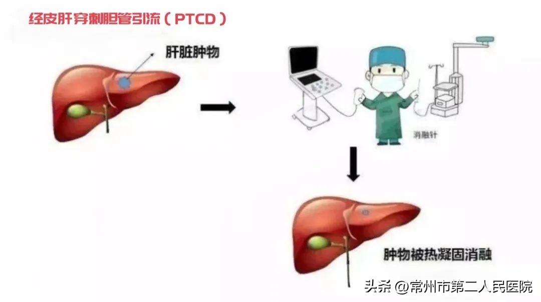 小针孔，用途多，漫画带你了解介入超声能做啥？
