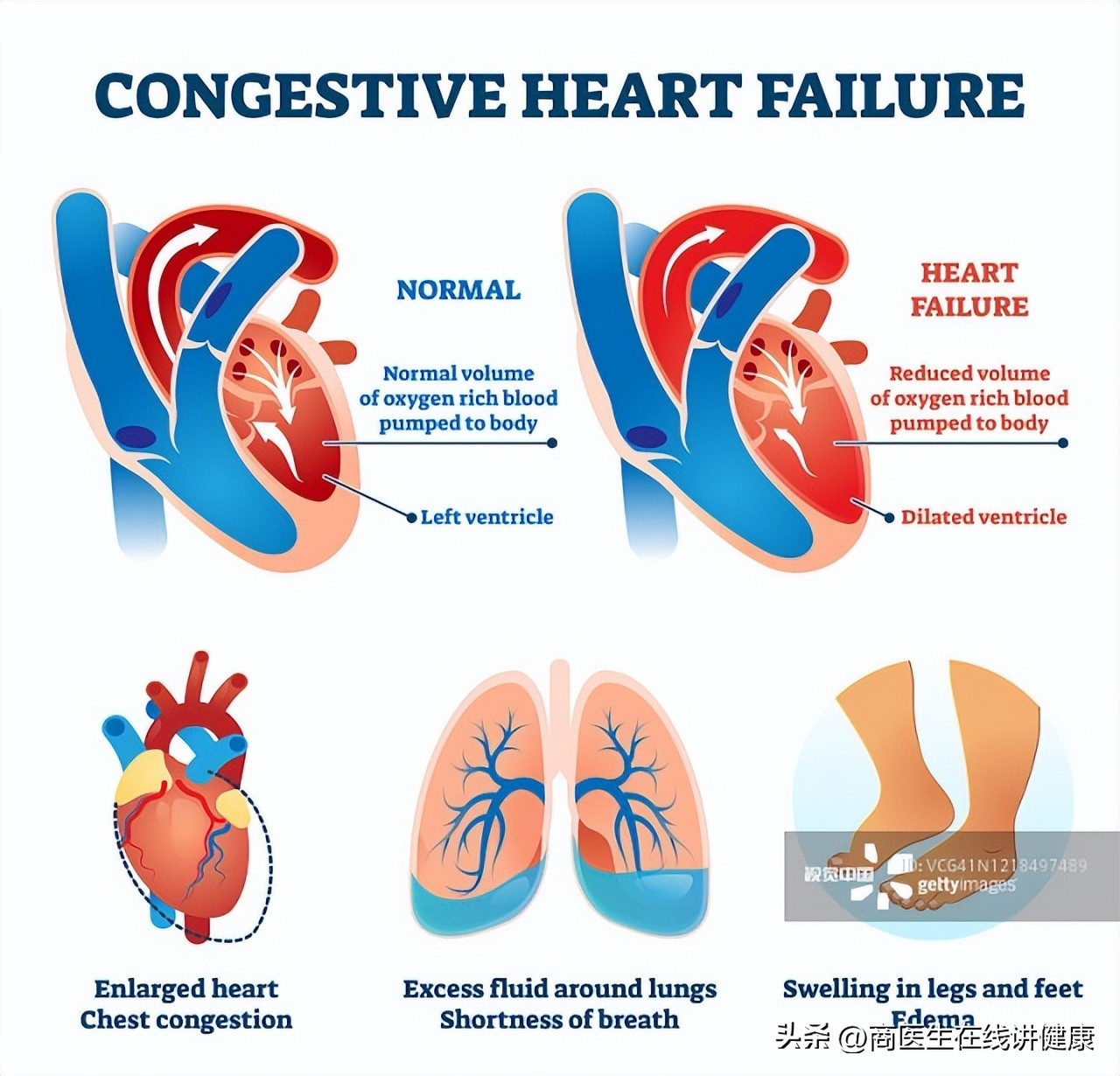 降糖药达格列净长期吃有什么害处,降糖药物达格列净有什么优势