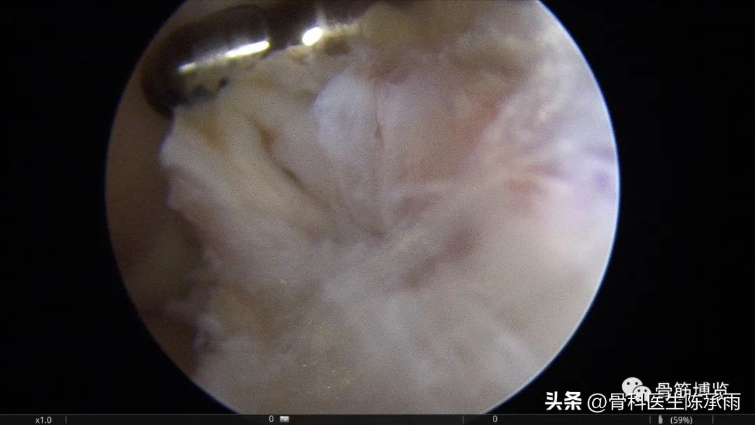 内侧半月板前角囊肿,关节镜下内侧半月板部分切除术