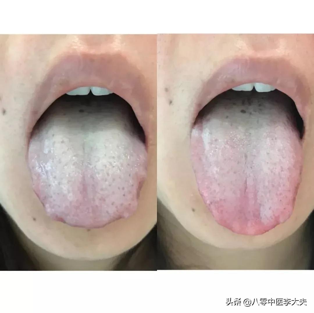 啤酒肚，大肚腩，痰湿壅盛？二陈汤，燥湿化痰，利湿，消除大肚腩