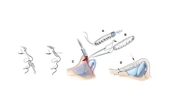 九院韦敏隆鼻案例图,上海九院隆鼻专家韦敏