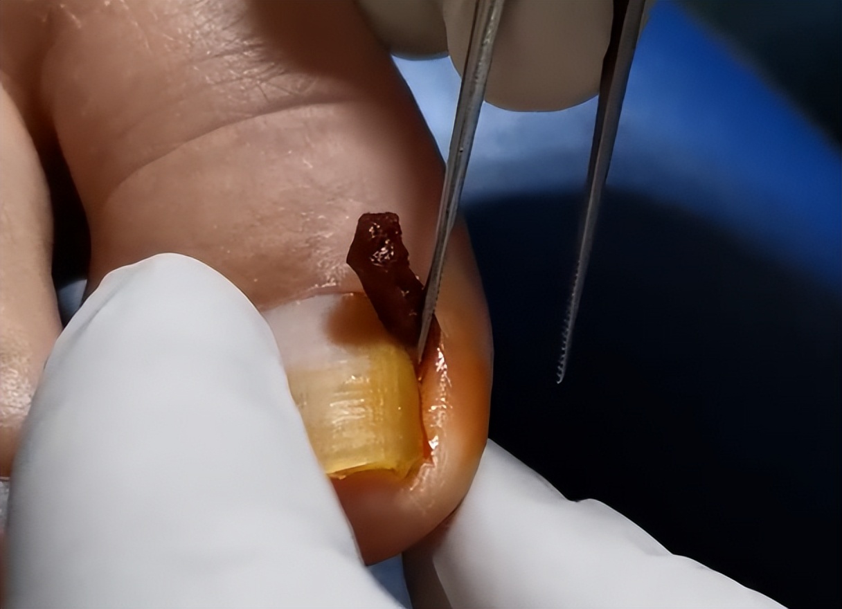 如何预防嵌甲,嵌甲预防方法科普视频