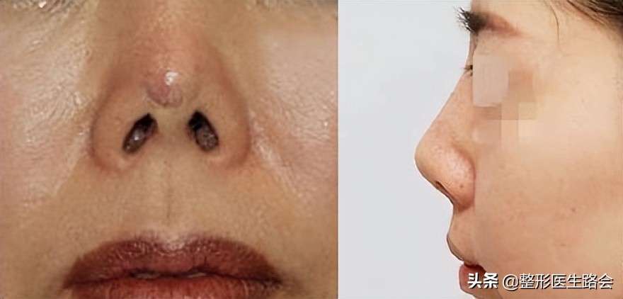 为什么隆鼻很久了鼻子还会歪,隆鼻了怎么确定鼻型歪不歪