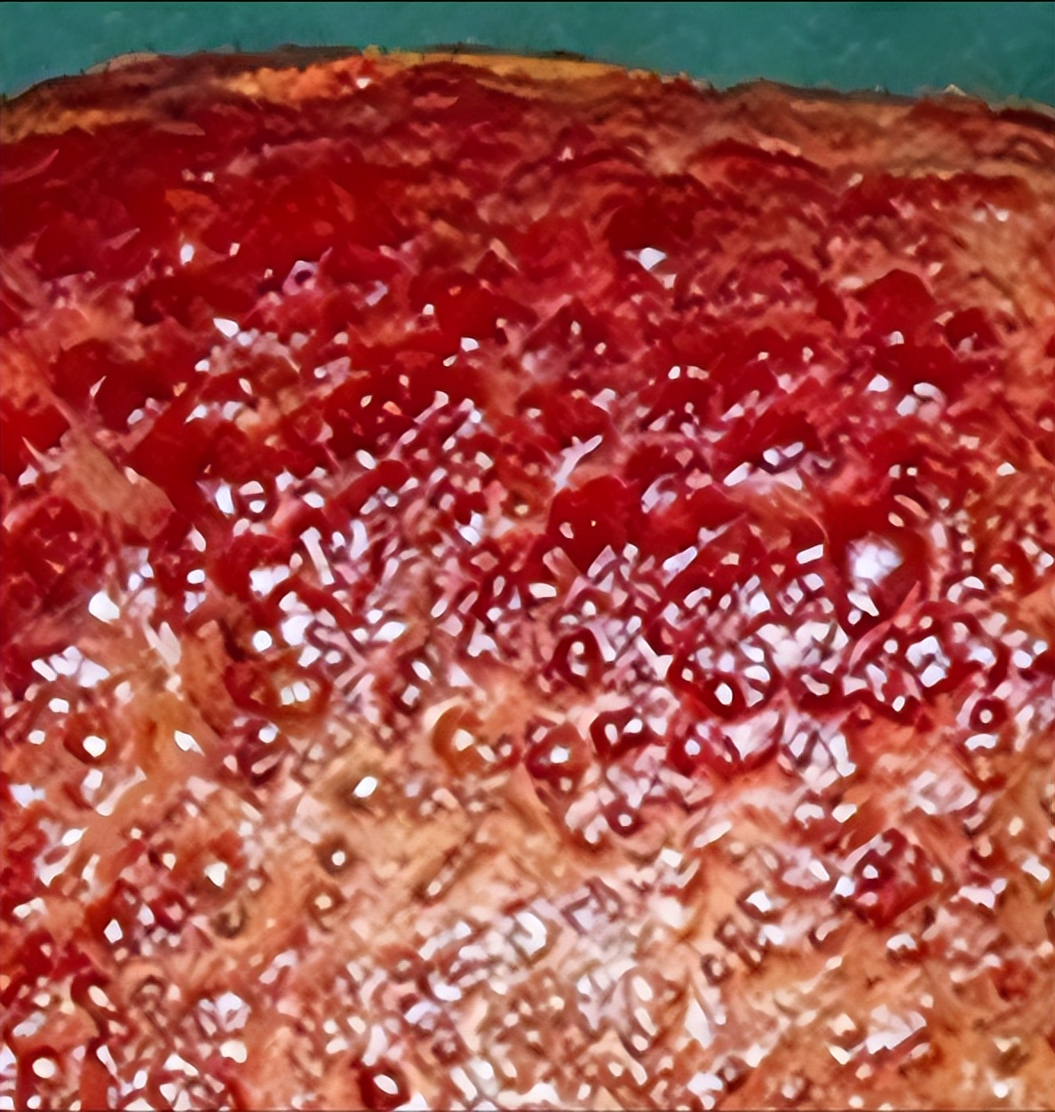 乙肝抗病毒5年肝回声欠均匀,乙肝抗病毒期间肝硬度f2算严重吗