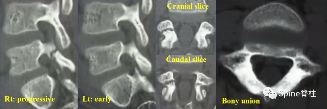 轻度峡部裂和重度峡部裂的区别,真性峡部裂和假性峡部裂