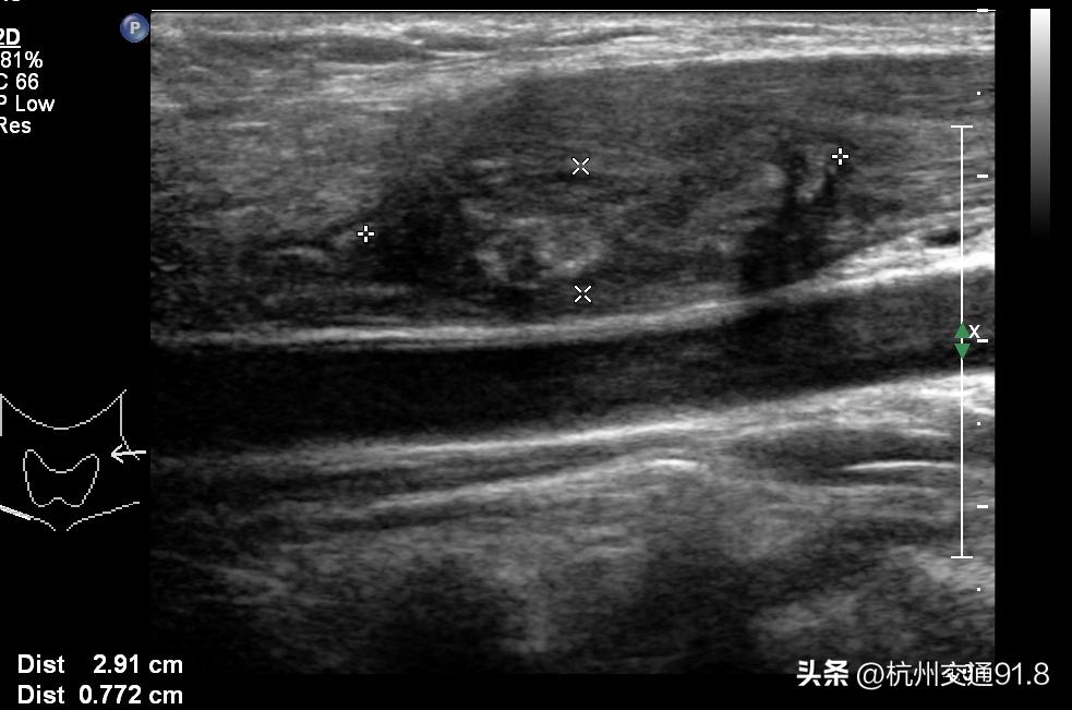 杭州小伙吃完烧烤脖子痛，以为“上火”了，结果是个大“漏”！