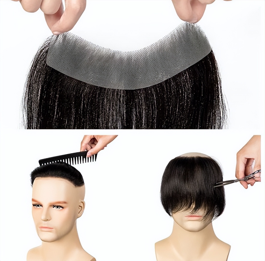 发际线后移遗传吗,发际线后移怎么办适合什么发型