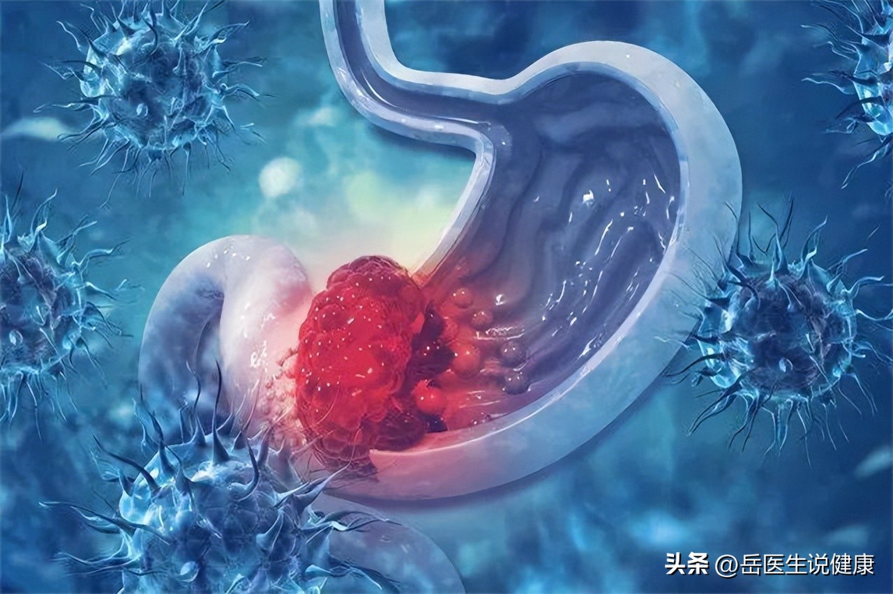 22岁男子确诊6种胃癌,33岁男子查出胃癌常吃一种早餐