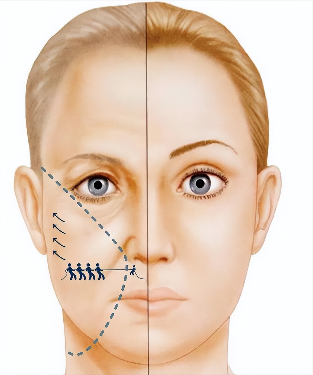 苹果肌塌陷不饱满怎么办,苹果肌干瘪怎么办