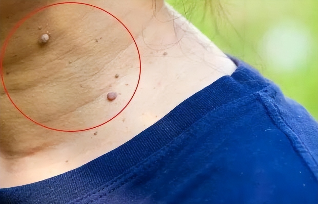 脖子上长小肉粒被自己揪掉了,脖子上的小肉粒揪掉后会怎样