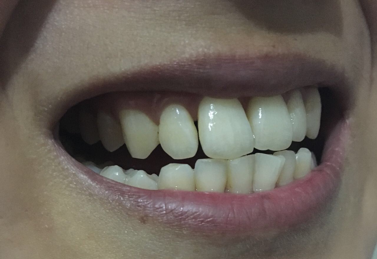 牙齿有了黑三角怎么办,牙齿间出现了黑三角怎么处理