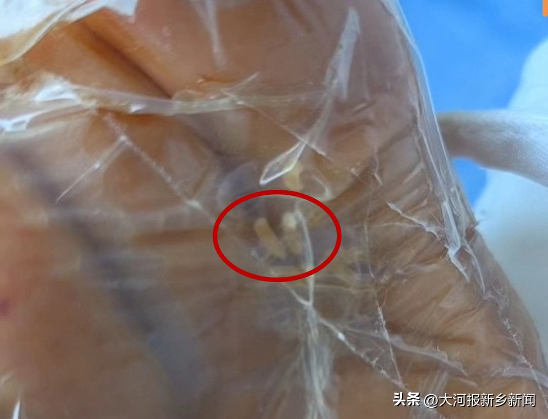 新乡女子术后监护室,女子住进icu病房