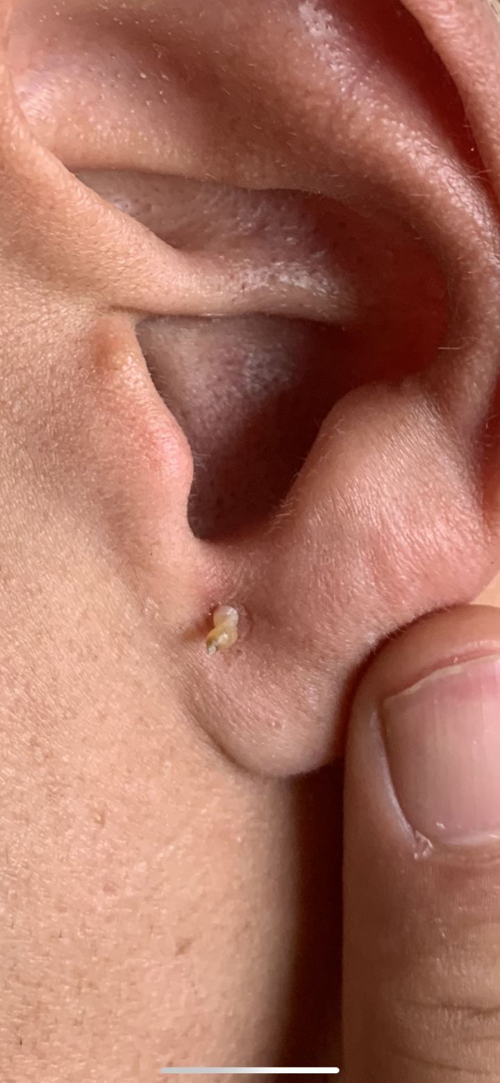 20年的黑头有多大,世界上最长的黑头到底有多长