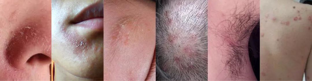 拿皮炎不当病？说的是你么