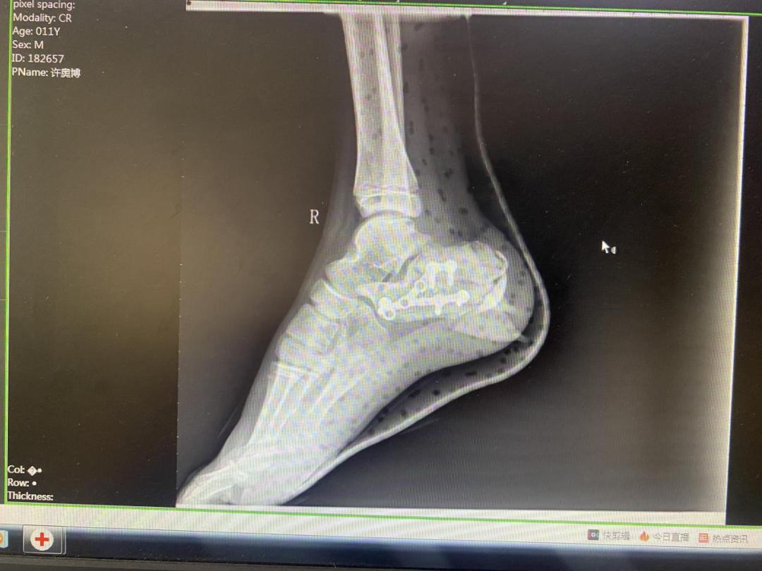 跗骨窦手术能治好吗,跗骨窦入路治疗跟骨骨折适应症