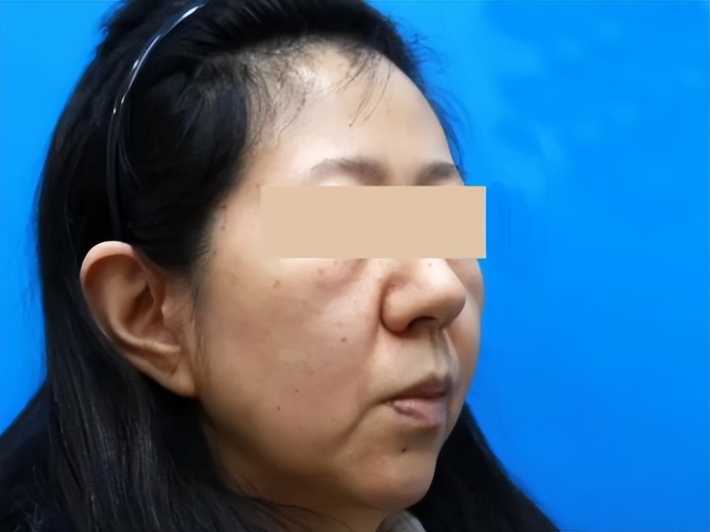 轮廓线打造和吸脂,面部轮廓线吸脂