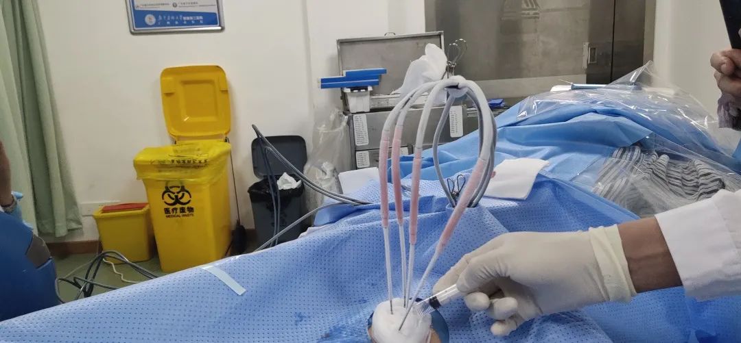 再次复查有所好转,氩氦刀冷冻消融术后患者不烧不痛