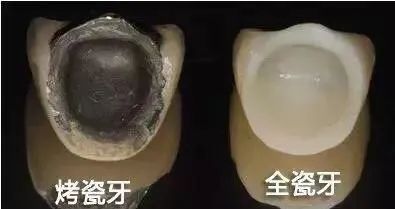 全瓷牙和烤瓷牙哪个质量好一点,全瓷牙和烤瓷牙的图片对比