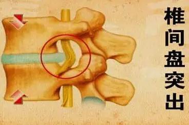 孙思邈治疗腰痛经方用量,孙思邈治疗腰椎间盘突出良方