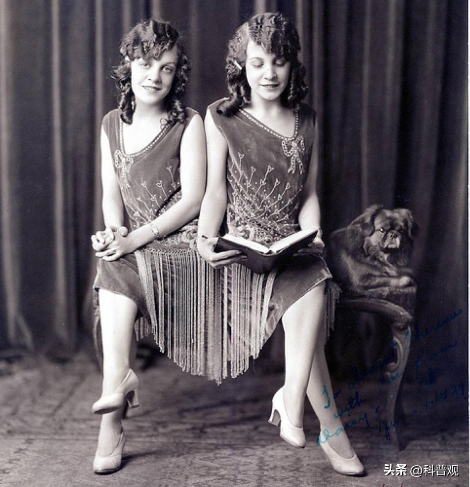 连体人一人去世了另一人会死吗,连体人死亡对另一半有影响吗