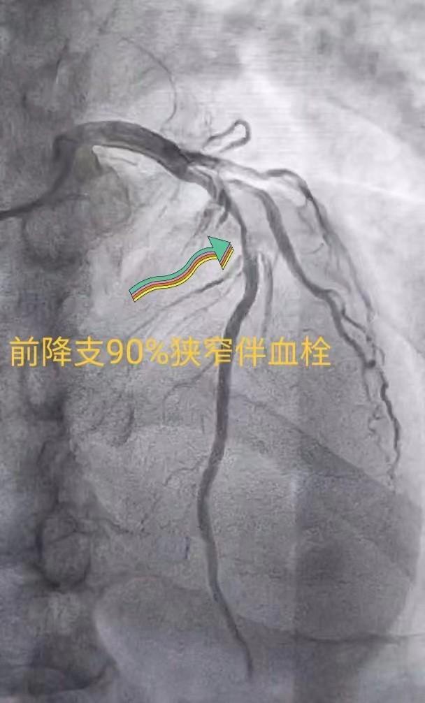 西安市红会医院：肚子疼痛多日检查后竟是心梗医生：警惕无痛性心肌梗死