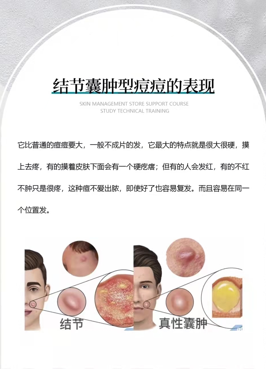 囊肿型痘痘怎么避免,痘痘形成的囊肿怎么去除