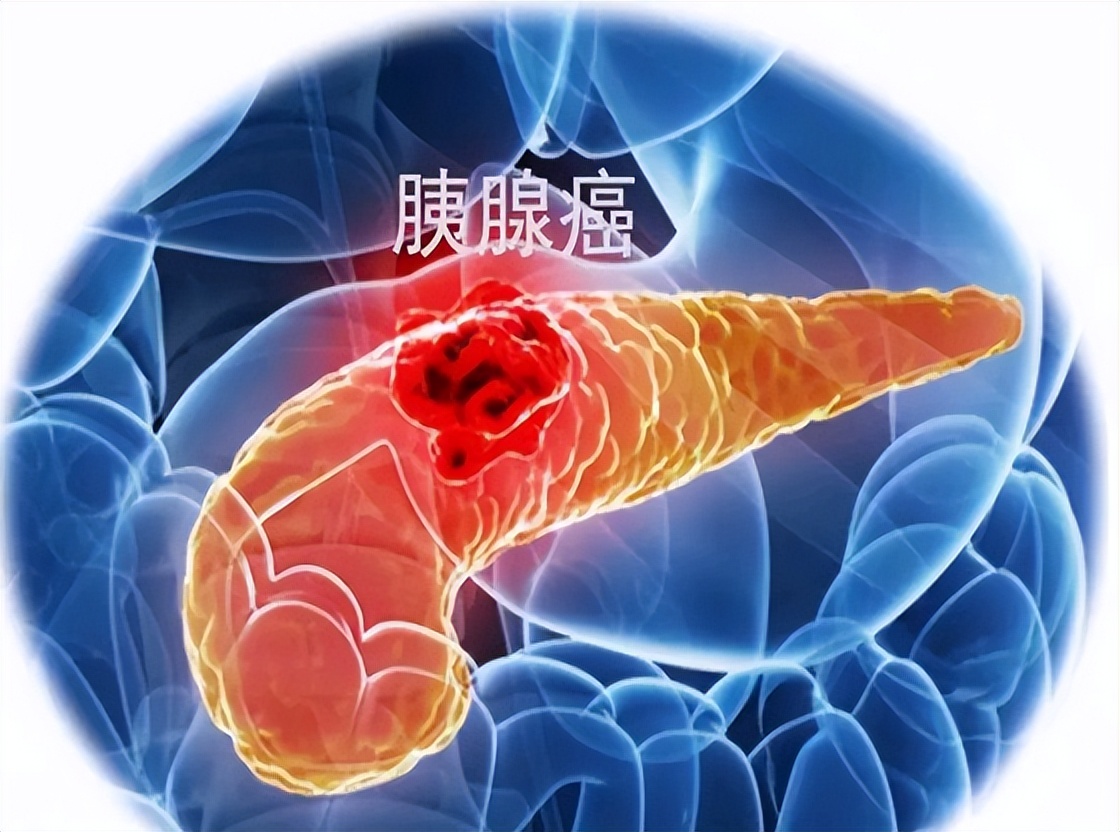 慢性炎症或可增加患癌风险，如何“消炎”？做好这7点