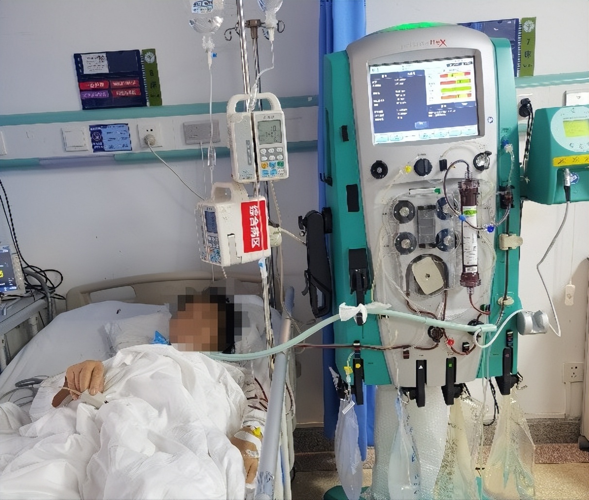 双下肢横纹肌肉溶解症,下肢肿胀鉴别诊断