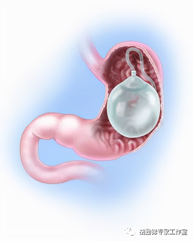 肥胖治疗新*器武**?胃里放个“球”就能减肥?