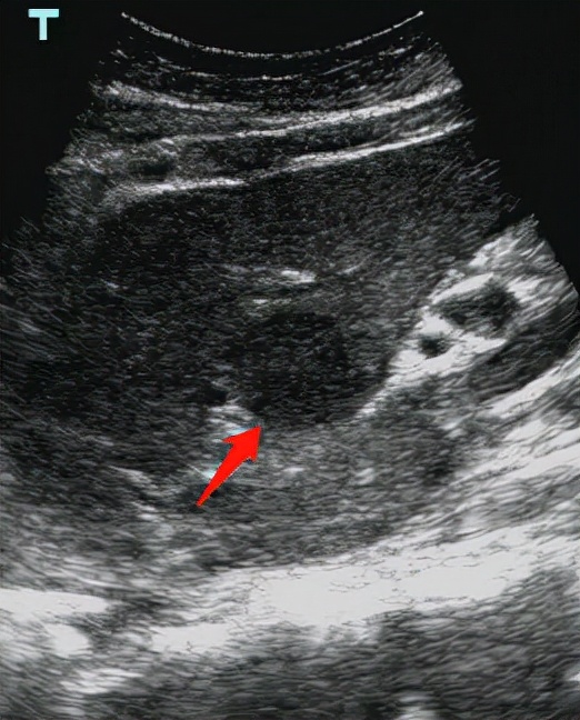 腹部彩超能查出什么病,腹部彩超能查出什么癌症吗