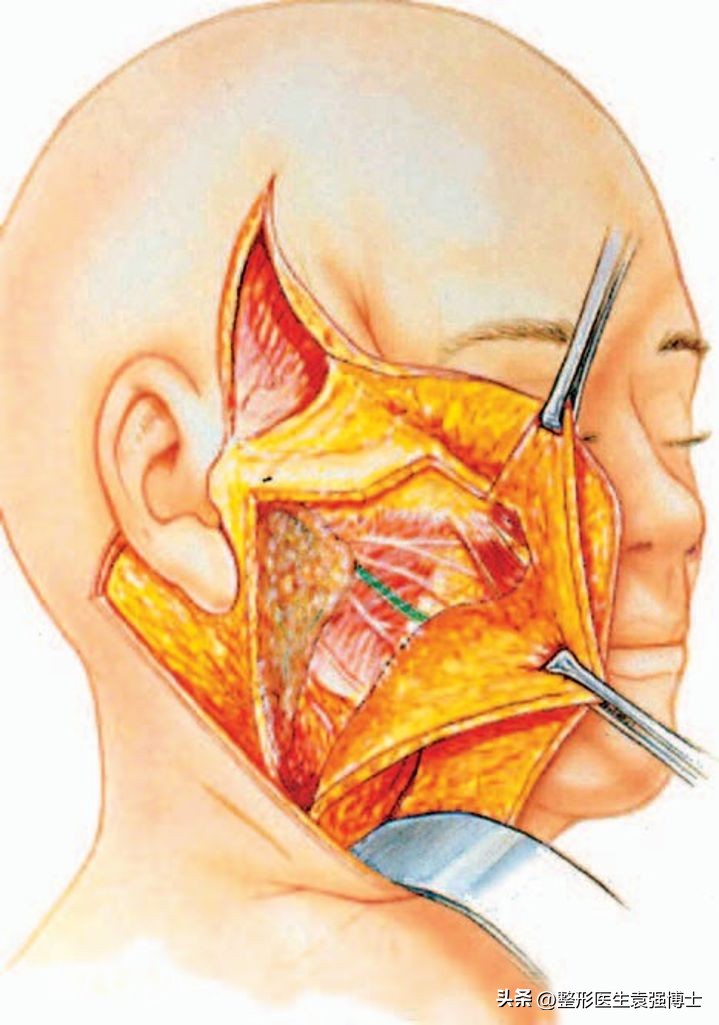 拉皮手术前后的感受,拉皮手术全面解答