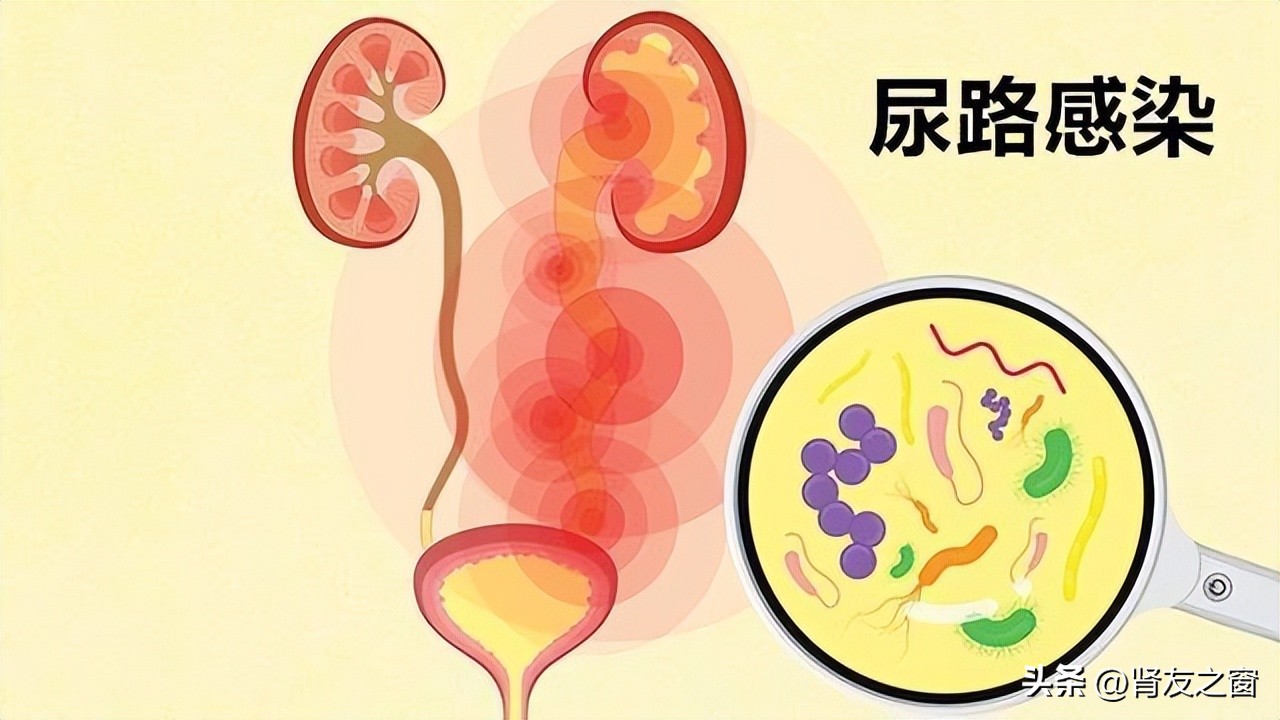 当2型糖尿病遇上尿路感染（二）