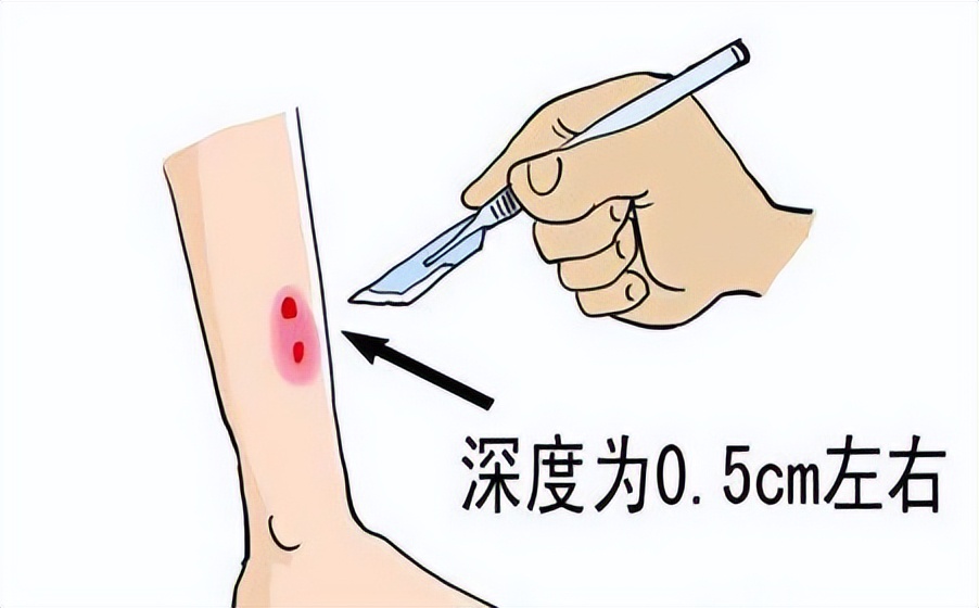 被毒蛇咬伤后救治,湘潭毒蛇咬伤救治