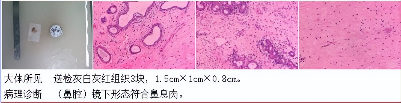 反复鼻塞,好不了,这次总算找到了原因