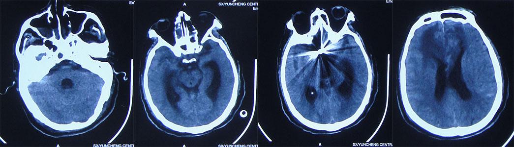 前交通动脉瘤破裂后开颅治疗风险,脑前交通动脉瘤破裂出血