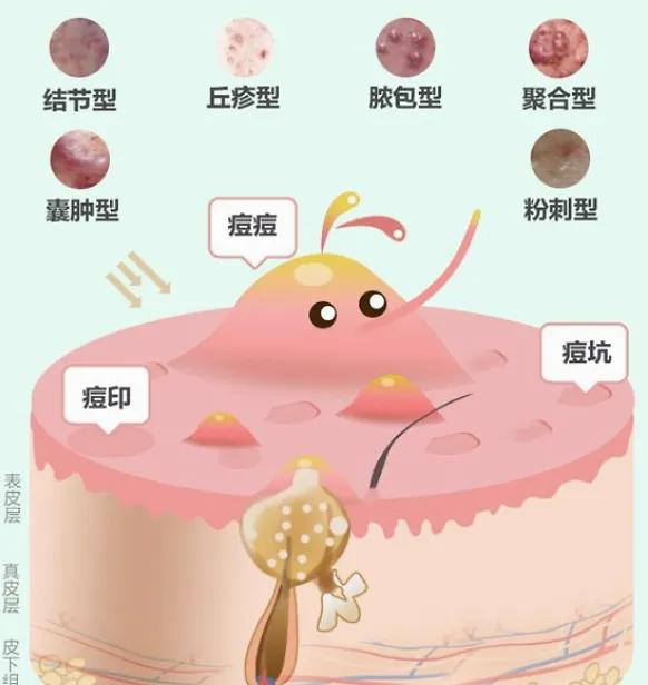 疱疹的中医辨证论治,疮的中医辨证论治