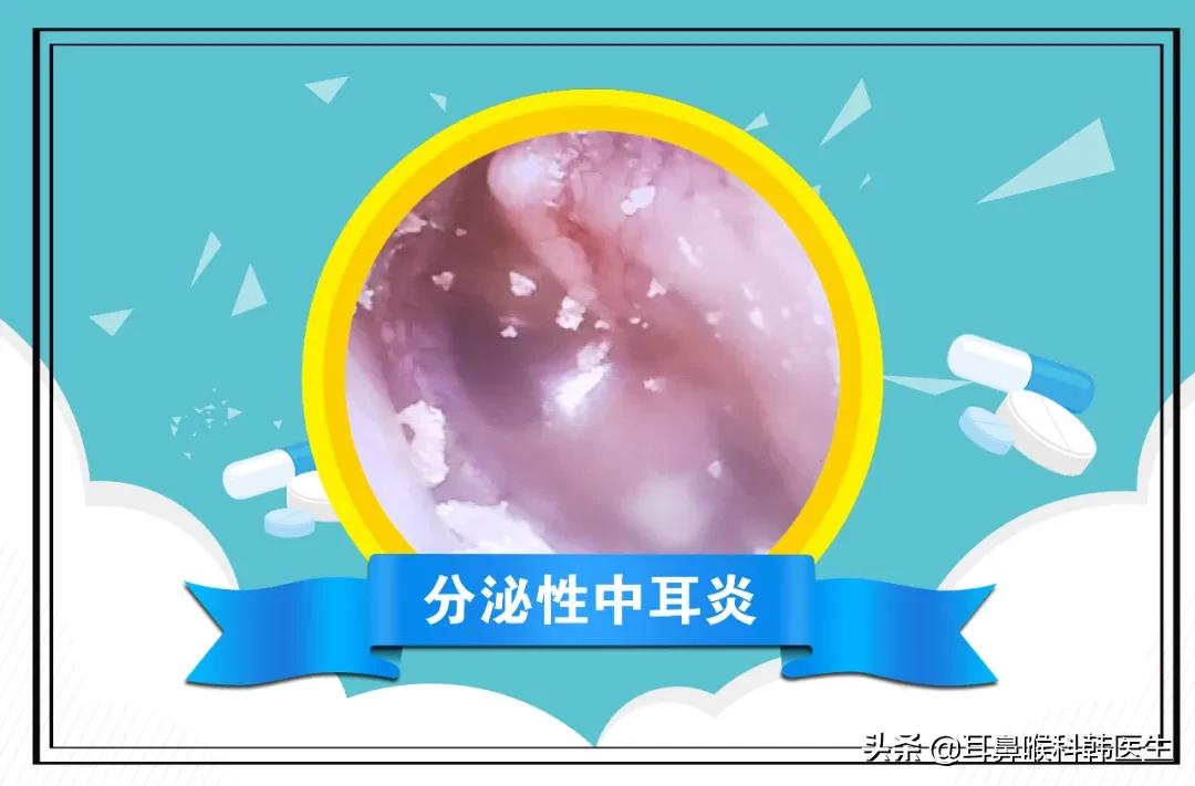 耳鼻咽喉镜检查痛不痛,耳鼻咽喉内窥镜检查是检查什么