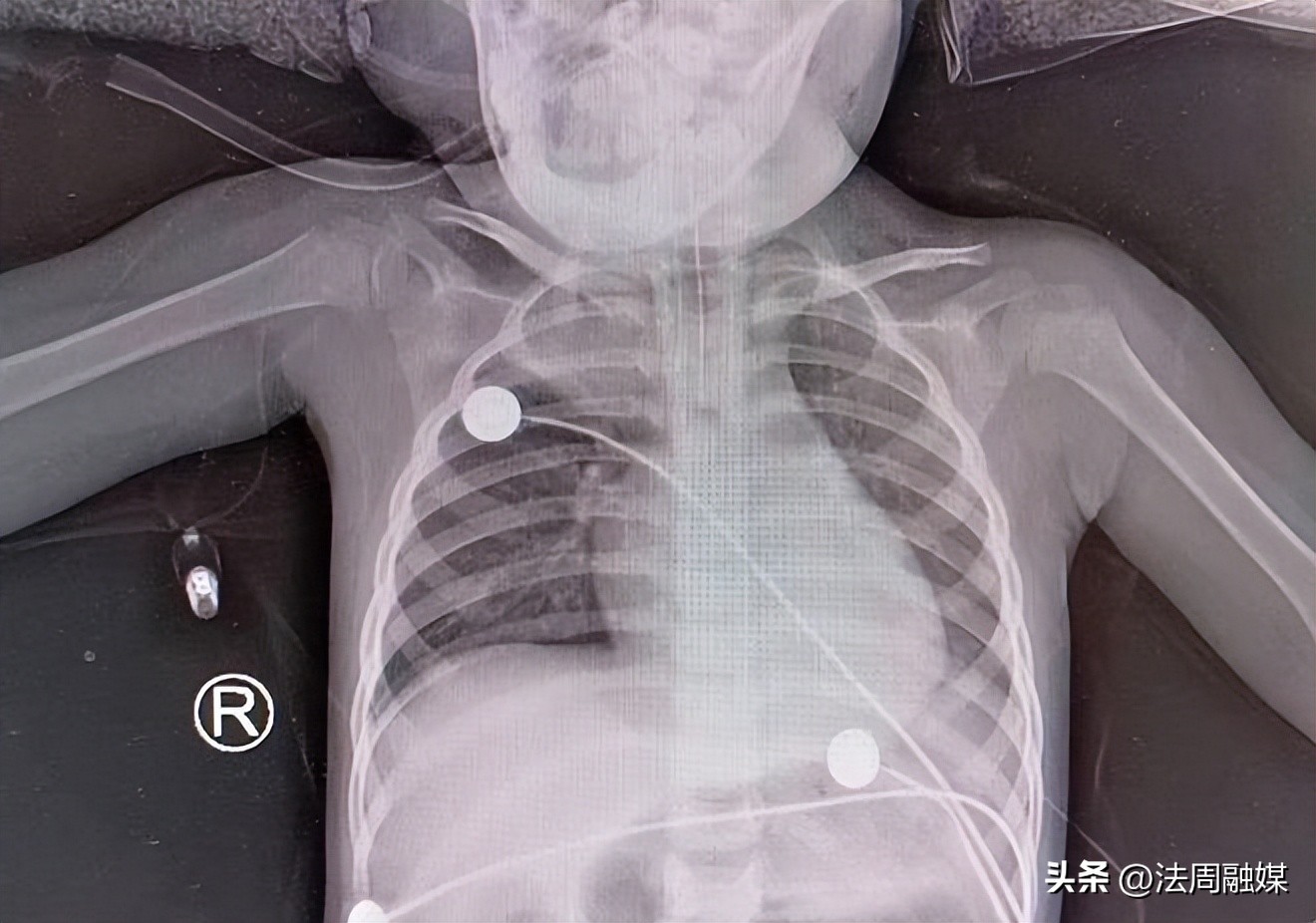 孩子坚果卡喉致死,婴幼儿吃坚果卡喉咙案例