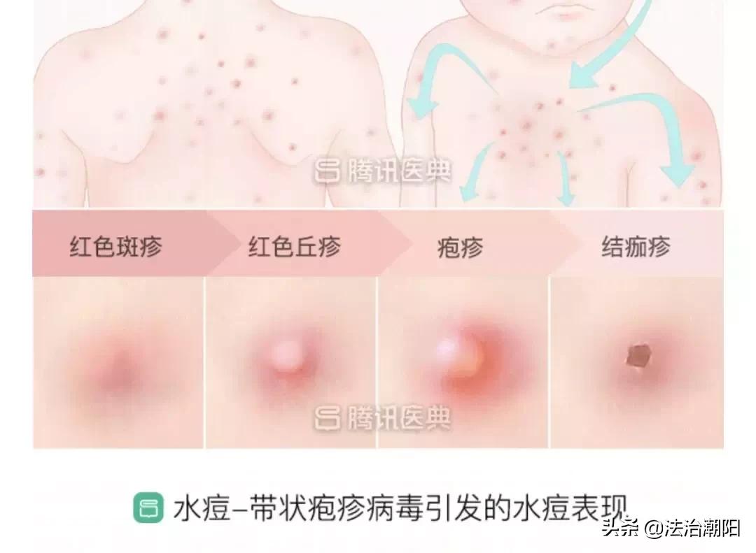 什么？我都奔4了还能得水痘？！