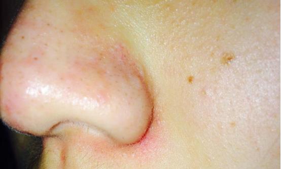 鼻周脱皮快速补救,鼻周斑去除小技巧