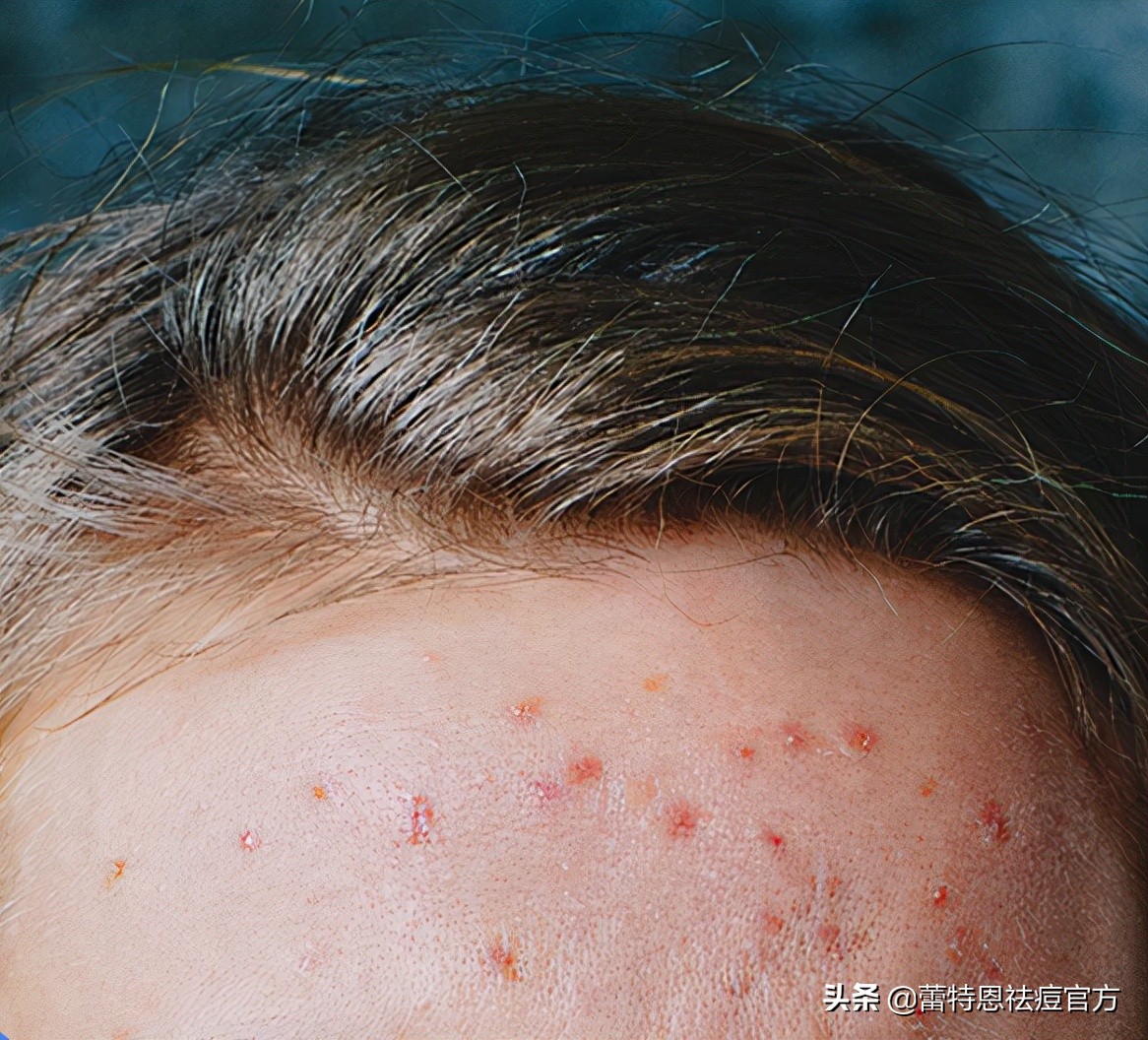 蕾特恩痘印,蕾特恩祛痘留下痘印