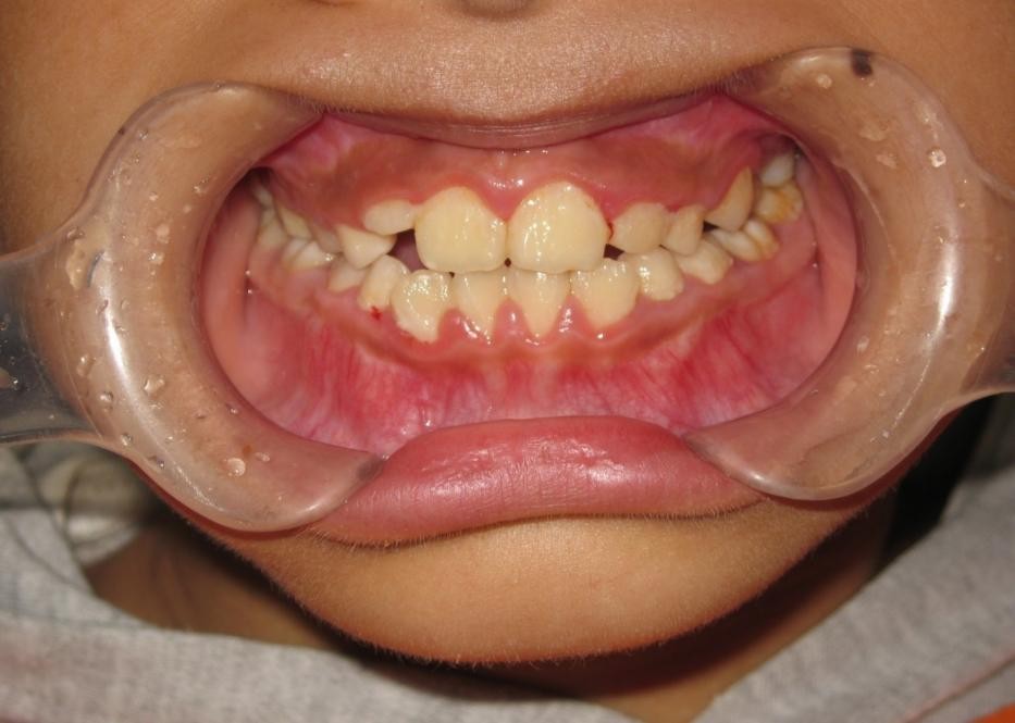 徐州儿童牙齿矫正牙齿不齐,大连口腔医院儿童牙齿矫正怎么样