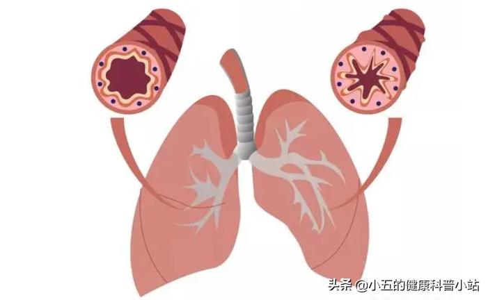 乙酰半胱氨酸片有抗炎作用吗,乙酰半胱氨酸片可用于雾化吗